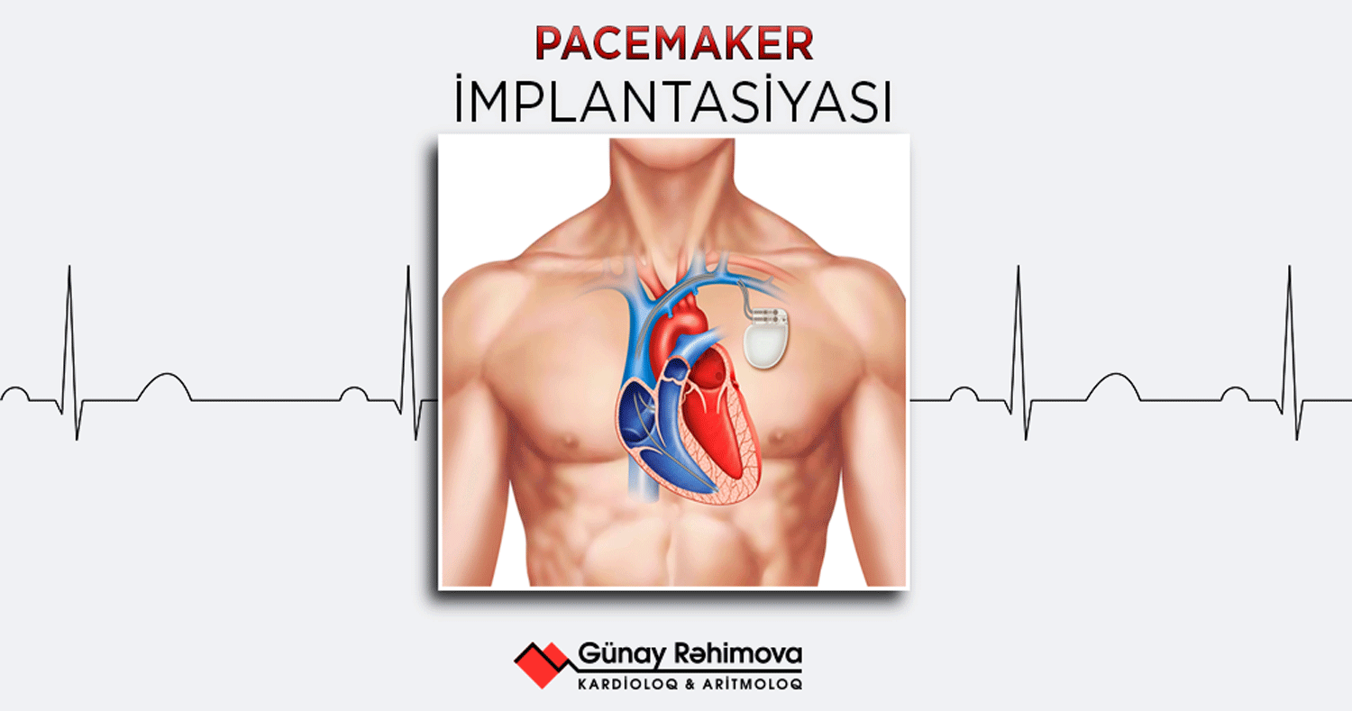 stimulyator-pacemaker-cihaz-implantasiyası